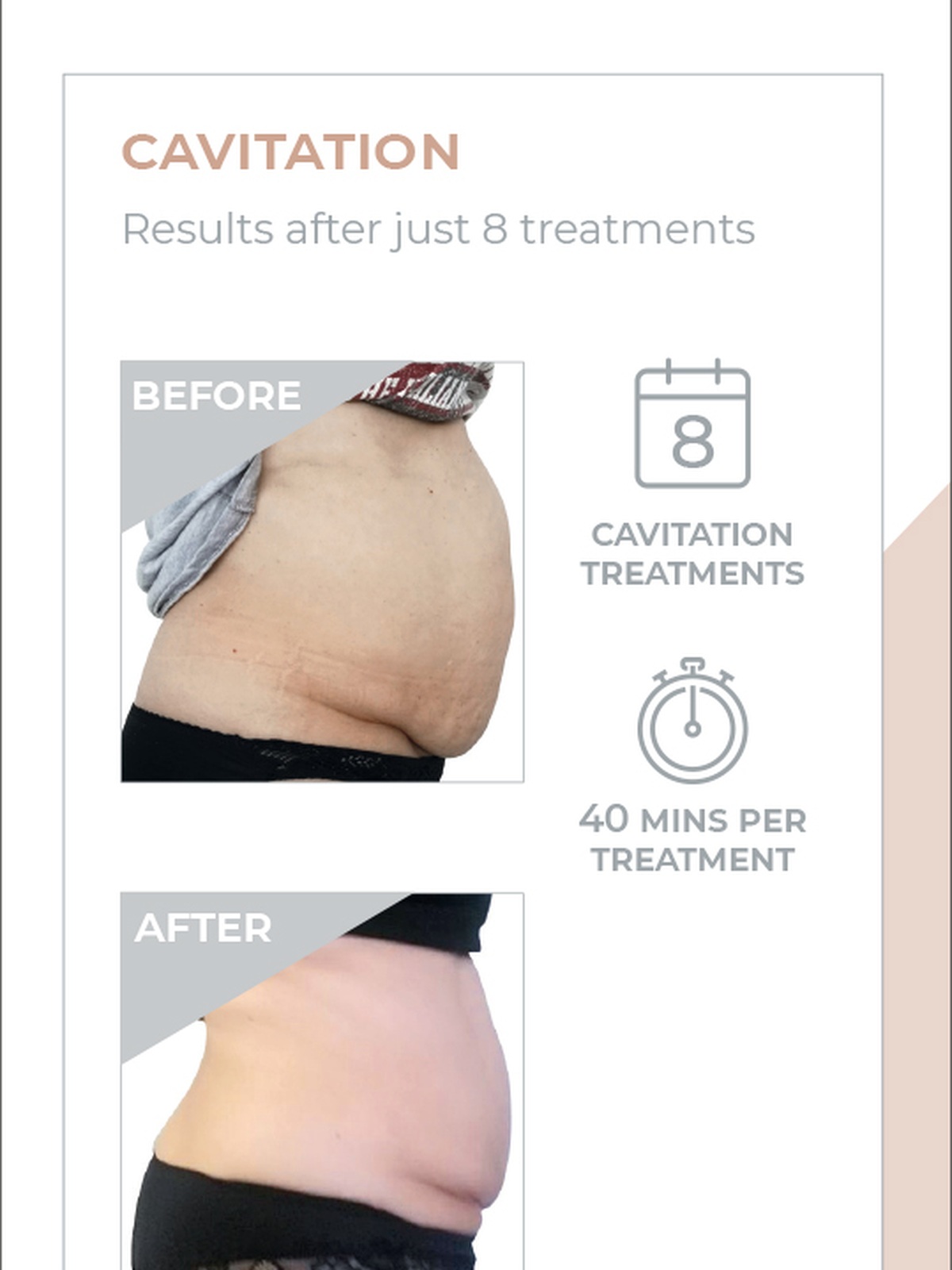 3D Lipo cavitation before and after treatment example