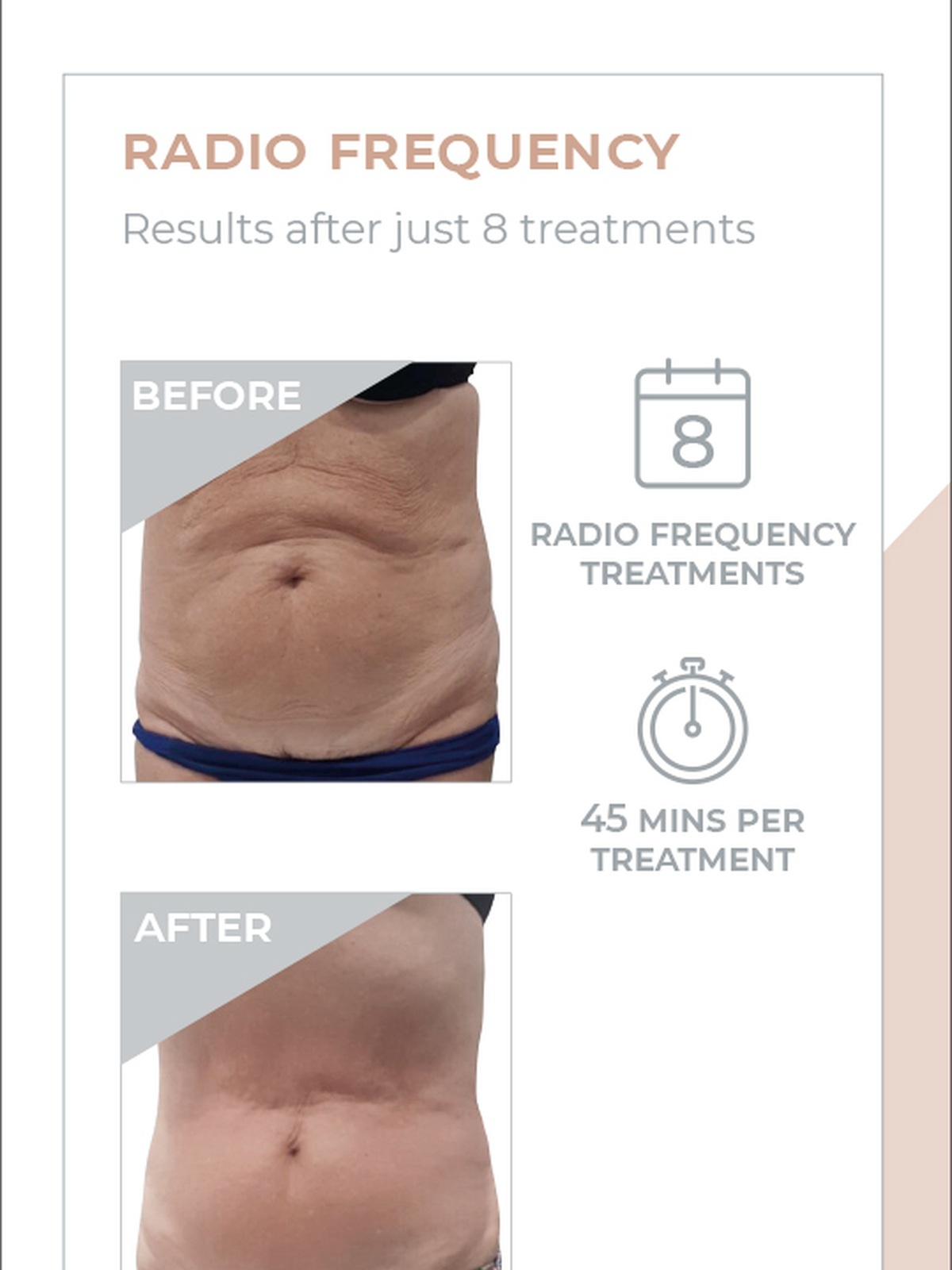 3D Body Contouring result