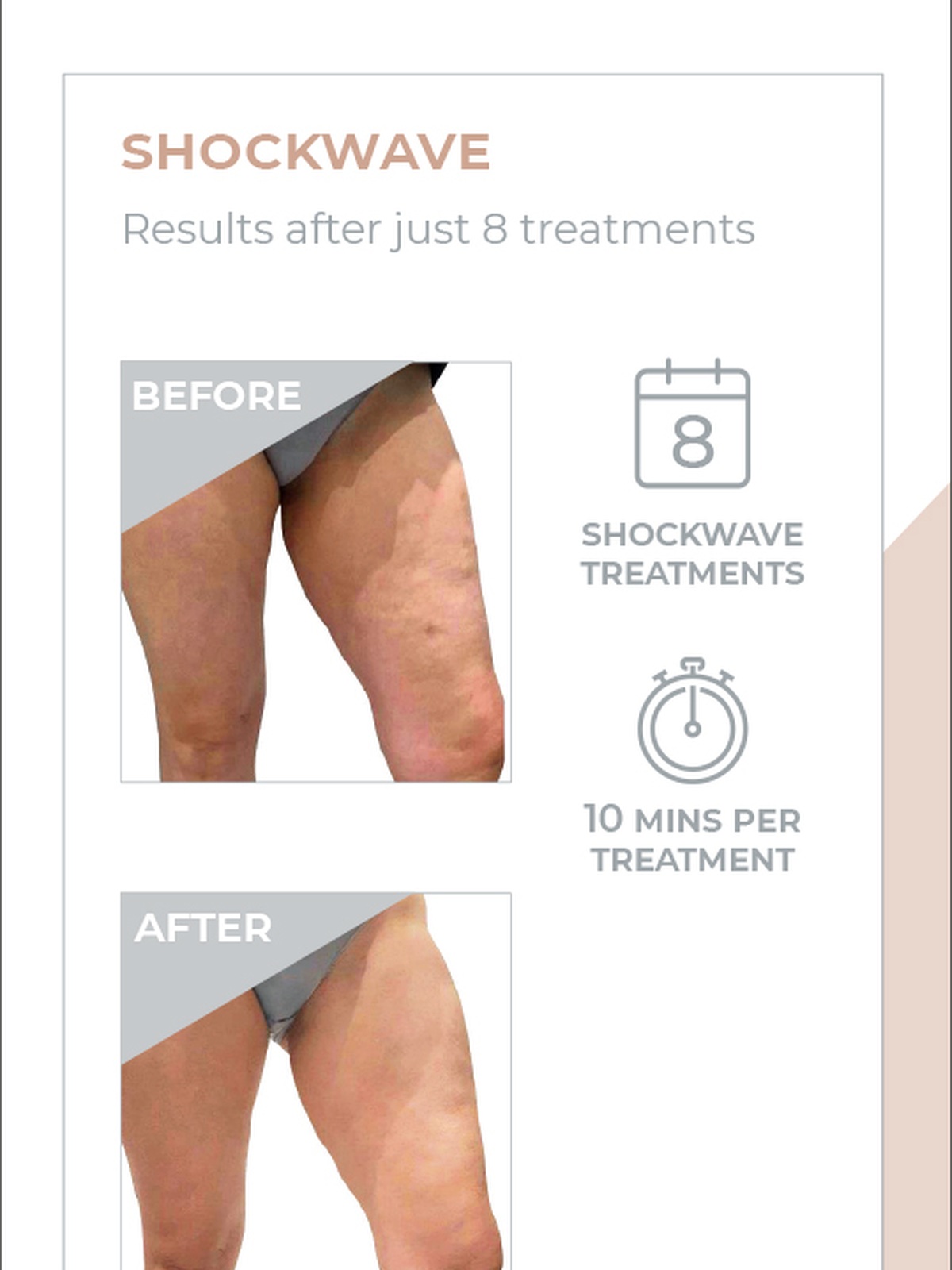 3D Lipo shockwave before and after treatment example