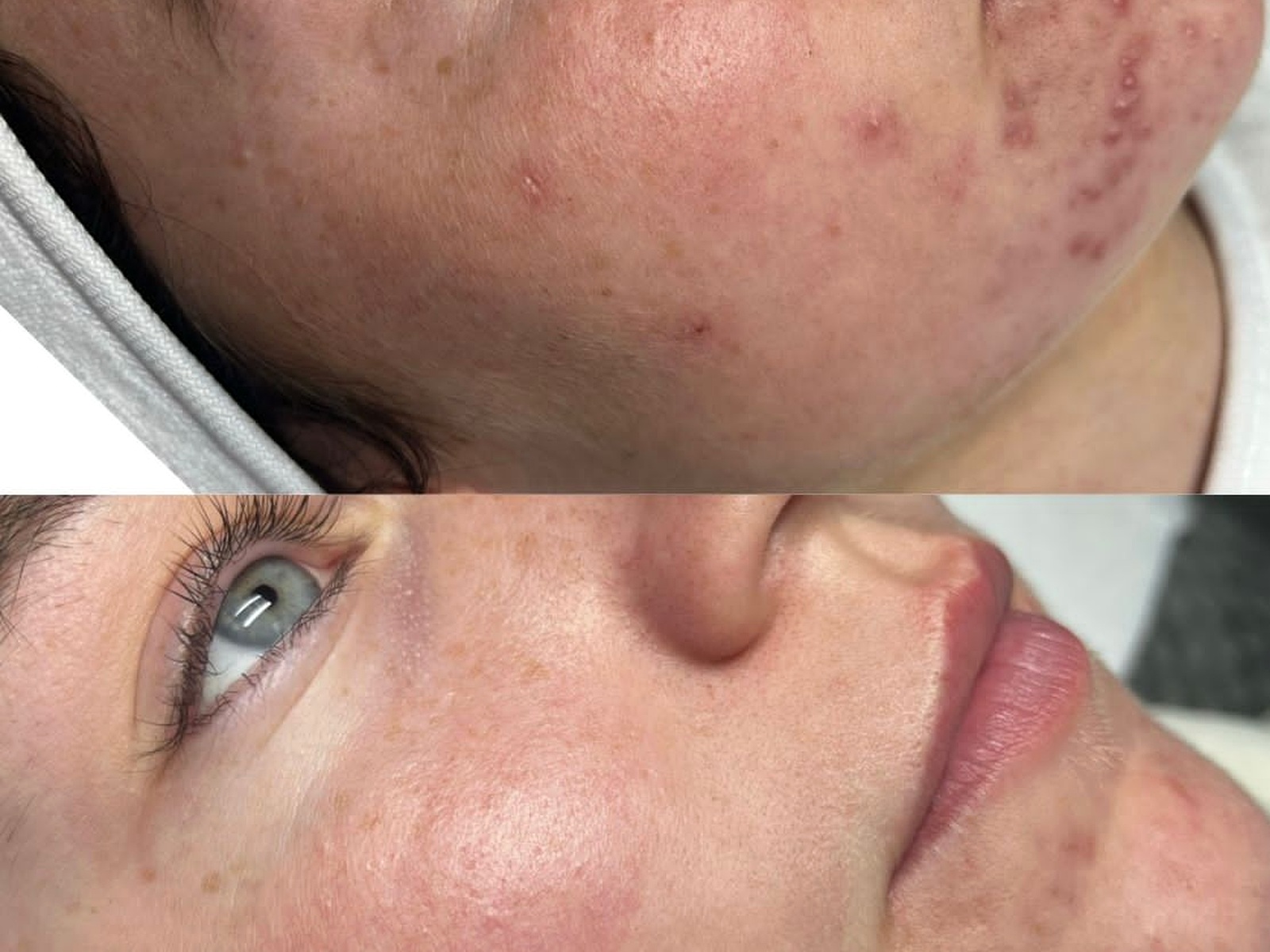 Before and after comparison following professional skin treatment