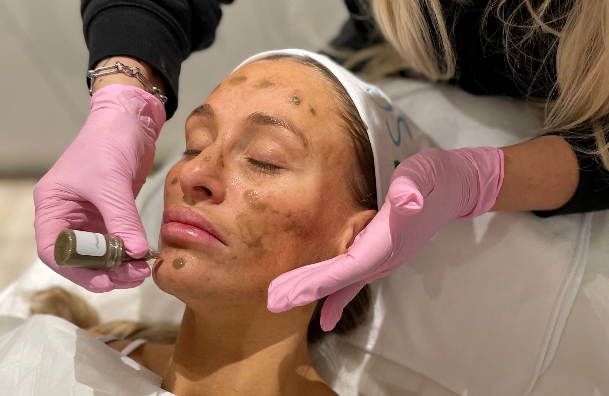 SQT Bio-Microneedling treatment